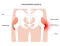 Bursitis inflammation concept