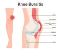 Bursitis. Knee joint inflammation. Inflamed or irritated bursae of synovial