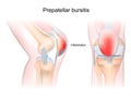 Bursitis of human knee joint. Prepatellar bursitis Royalty Free Stock Photo