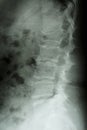 Burst fracture at lumbar spine