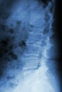 Burst fracture at lumbar spine