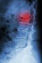 burst fracture at lumbar spine