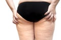 Buttock and leg cellulite problem young fat woman stretch marks