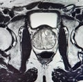 Ca prostate mri exam diagnostic