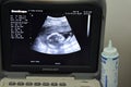 A monitor of a portable ultrasonography showing the head of a fetus with a gestational age GA 18 weeks and 4 days Royalty Free Stock Photo