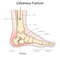 Calcaneus fracture diagram medical science