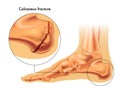 Calcaneus fracture