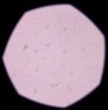 Calcium oxalate crystal in urine analysis.