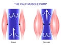 Calf muscle pump. Venous Health