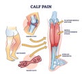 Calf pain explanation with cramp from muscle contraction outline diagram Royalty Free Stock Photo