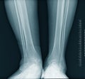 Calf x-ray Royalty Free Stock Photo