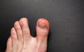 Callus blisters on man feet. Painful wounds. Uncomfortable shoes problems. Footballer`s legs