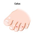 Callus or callosity Royalty Free Stock Photo