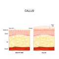 Callus. callosity Royalty Free Stock Photo