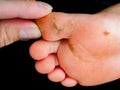 Callus on childs foot