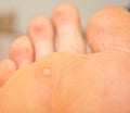 Callus and hyperkeratosis Royalty Free Stock Photo