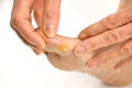 Callus on toe Royalty Free Stock Photo