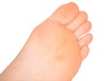 Callus under foot Royalty Free Stock Photo