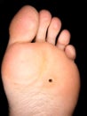 Callus under foot Royalty Free Stock Photo