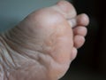 callus on a woman& x27;s foot Royalty Free Stock Photo