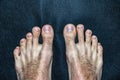 Callused and dirty foots of a man with long and dirty finger nails