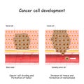 Cancer cell development. Tumor Formation