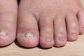 Cancer chemotherapy cause swelling of ankles . skin to become dry, dark or peel and nails brittle or flaky