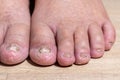 Cancer chemotherapy cause swelling of ankles . skin to become dry, dark or peel and nails brittle or flaky