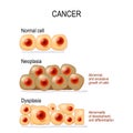 Cancer. Normal cells, Dysplasia, and Neoplasia Royalty Free Stock Photo