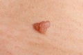 cancer papilloma on the skin, wart close up