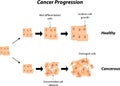 Cancer Progression Royalty Free Stock Photo