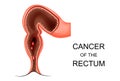 Cancer of the rectum