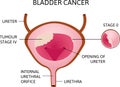 Cancer of urinary bladder. Tumor in bladder with inscriptions on it