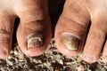 Candida Albicans toe nail