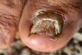 Candida Albicans toenail