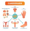 Candidiasis medical vector illustration diagram poster with all types of candida fungus on various human body parts and organs. Royalty Free Stock Photo