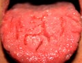 Candidiasis in the tongue. Fractured tongue. Thrush.