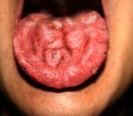 Candidiasis in the tongue. White coating. Fractured tongue. Thrush.