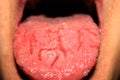 Candidiasis in the tongue. White coating. Thrush.