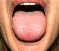 Candidiasis in the tongue. White coating. Thrush.