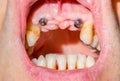 Canine dental implants in the mouth of a patient with advanced p