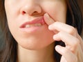 Canker sore on woman upper lip Royalty Free Stock Photo