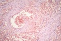Capillary hemangioma, light micrograph