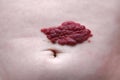 Capillary hemangioma red birthmark on the baby`s belly