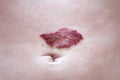 Capillary hemangioma regression. Red birthmark on the baby`s belly after treatment Royalty Free Stock Photo