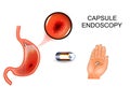 Capsule endoscopy, EGD, gastroenterology.