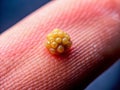 Detailed CloseUp of a Tiny Wart on a Finger A Dermatological Illustration Showing Skin Texture and Detail in