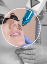 Carbon face peeling procedure in a beauty salon. Hardware cosmetology treatment Royalty Free Stock Photo