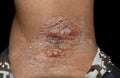 Carbuncle and folliculitis with surrounding cellulitis or Staphylococcal / Streptococcal skin infection in axilla of Asian Burmese Royalty Free Stock Photo