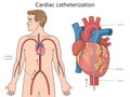 Cardiac catheterization diagram medical science